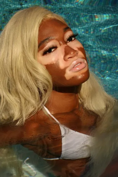 Vitiligo može početi u bilo kojoj životnoj dobi, no najčešće se pojavljuje između 10. i 30. godine života.