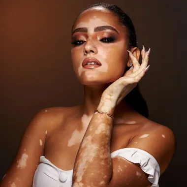 Iako se može pojaviti kod osoba svih boja kože, vitiligo je obično izraženiji kod osoba s tamnijom kožom.