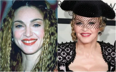 Prije nekoliko desetaka godina, Madonna je imala biserno bijele zube, s prepoznatljivim razmakom između dva prednja zuba. Danas i dalje ima predivne bijele zube, no razmak joj se smanjio.