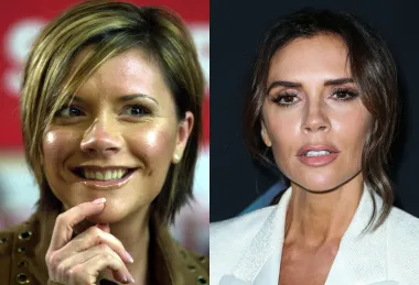 Prije no što je postala jedna od najbogatijih žena u Velikoj Britaniji, bivša spajsica Victoria Beckham imala je tipične &apos;engleske&apos; zube. Iako je danas rijetko kad možemo vidjeti nasmiješenu, njezini su zubi pravilni i blistavo bijeli pa se pretpostavlja da je stavila ljuskice.