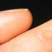 Život s bradavicama je život s HPV-om