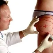 Liposukcija – do manje centimetara za samo nekoliko sati