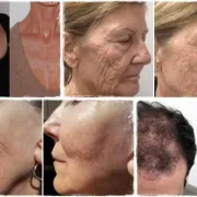 Vampirski Facelift – PRP
