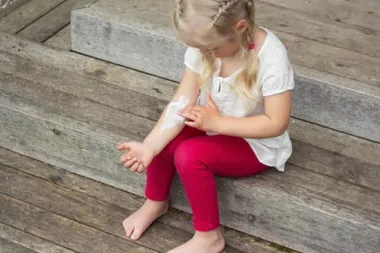 Atopijski dermatitis i njegov utjecaj na svakodnevni život