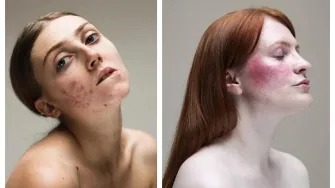 Iza šminke: Žene odbacuju stigmu 'nesavršene' kože u odličnom fotoprojektu