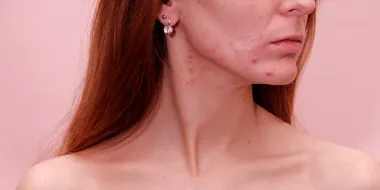 Hormonalne akne: Kratki vodič o povezanosti akni s menstrualnim ciklusom