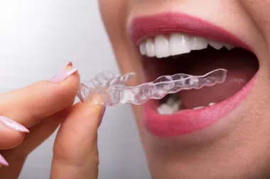 Želiš ljepše zube? Pitali smo stručnjaka na koje sve načine možeš to postići