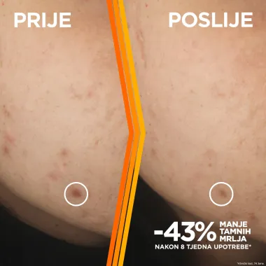 Dolaskom sunčanog perioda mnoge od nas bore se s pigmentacijskim mrljama: Ovo je mini vodič o tome kako one nastaju te kako ih spriječiti i sanirati