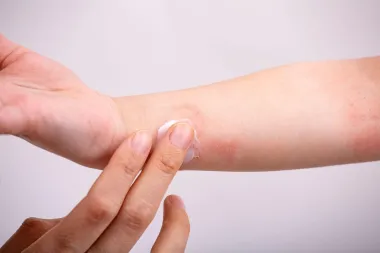 Pitali smo stručnjakinju: Atopijski dermatitis kod odraslih - njega i liječenje