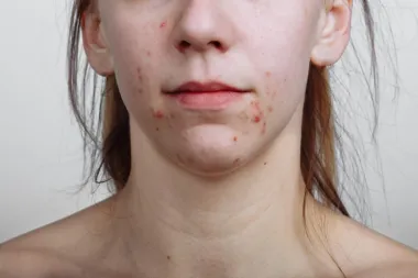 Problem za mnoge: Što uzrokuje akne u odrasloj dobi?